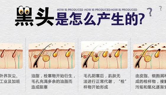 黑头怎么形成的？怎么引起的？可以挤吗？