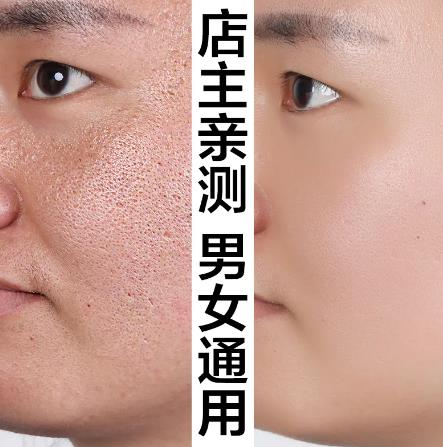 黑头粉刺怎么去掉？如何有效去除？