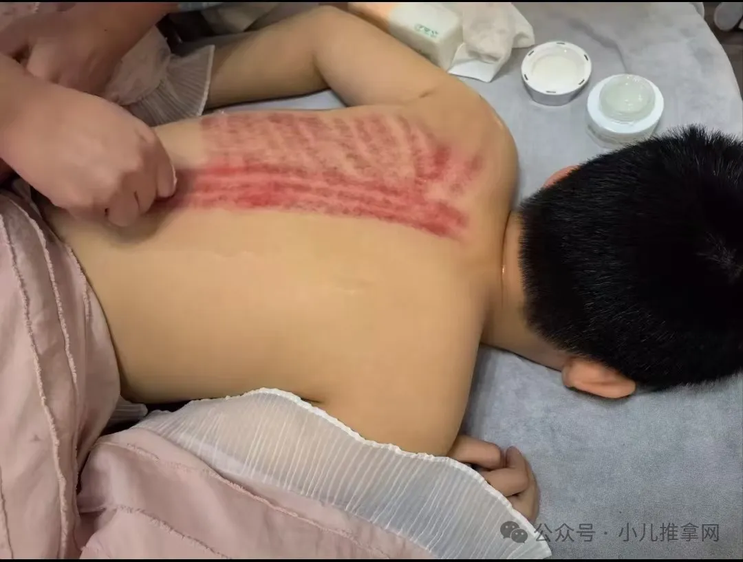 小儿推拿店儿童鼻炎、腺样体调理现场照片